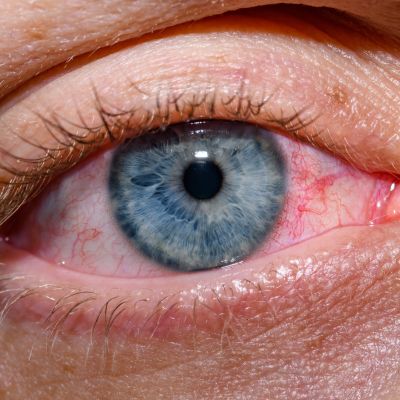 Open eye with blue iris and redness due to allergies