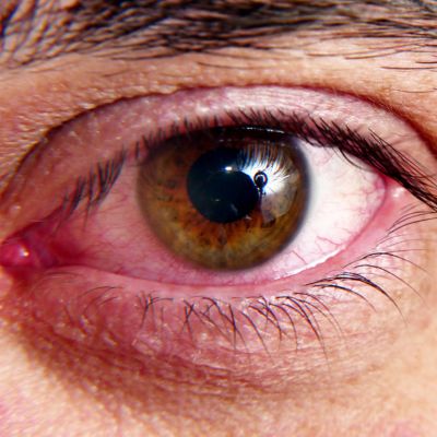 Close-up of a man's irritated eye