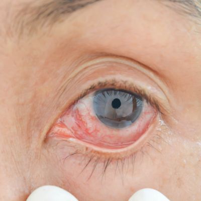 close-up of a person’s eye who is suffering from seasonal allergies
