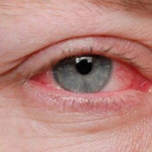 close-up of an eye with conjunctivitis symptoms