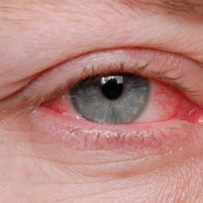 Common Misdiagnoses of Pink Eye Explored