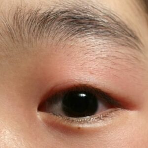 Makeup in eye irritation