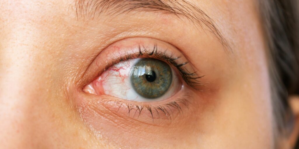 Closeup of a caucasian woman's eye that is red and irritated due to dry eye.
